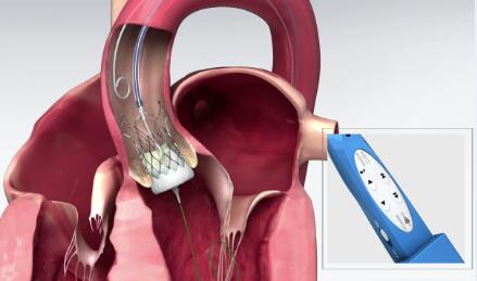 经导管主动脉瓣膜置换术